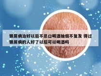 银屑病治好以后不忌口喝酒抽烟不复发 得过银屑病的人好了以后可以喝酒吗