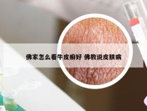 佛家怎么看牛皮癣好 佛教说皮肤病
