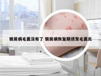 银屑病毛囊没有了 银屑病恢复期诱发毛囊炎