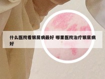 什么医院看银屑病最好 哪里医院治疗银屑病好