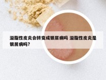 溢脂性皮炎会转变成银屑病吗 溢脂性皮炎是银屑病吗?