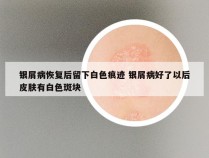 银屑病恢复后留下白色痕迹 银屑病好了以后皮肤有白色斑块