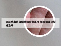 银屑病血热血燥情绪会怎么样 银屑病血热型好治吗