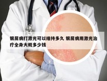 银屑病打激光可以维持多久 银屑病用激光治疗全身大概多少钱