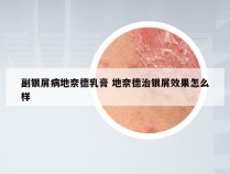 副银屑病地奈德乳膏 地奈德治银屑效果怎么样