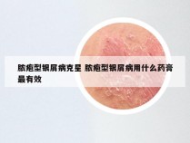 脓疱型银屑病克星 脓疱型银屑病用什么药膏最有效