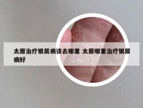 太原治疗银屑病该去哪里 太原哪里治疗银屑病好