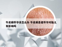 牛皮癣怀孕该怎么办 牛皮癣患者怀孕对胎儿有影响吗