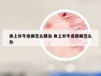 身上长牛皮癣怎么根治 身上长牛皮肤癣怎么办