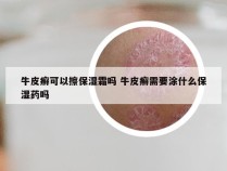 牛皮癣可以擦保湿霜吗 牛皮癣需要涂什么保湿药吗