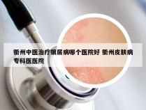 衢州中医治疗银屑病哪个医院好 衢州皮肤病专科医医院