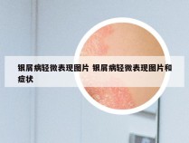 银屑病轻微表现图片 银屑病轻微表现图片和症状