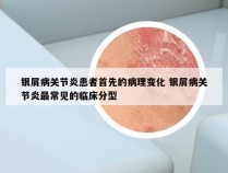 银屑病关节炎患者首先的病理变化 银屑病关节炎最常见的临床分型