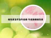 维生素治不治牛皮癣 牛皮肤癣维生素