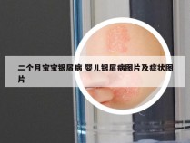 二个月宝宝银屑病 婴儿银屑病图片及症状图片