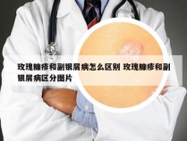 玫瑰糠疹和副银屑病怎么区别 玫瑰糠疹和副银屑病区分图片