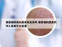 银屑病和体内激素有关系吗 银屑病的激素药对人体有什么危害