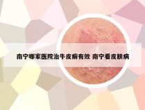 南宁哪家医院治牛皮癣有效 南宁看皮肤病