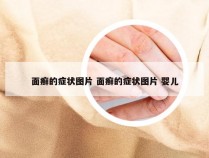 面癣的症状图片 面癣的症状图片 婴儿