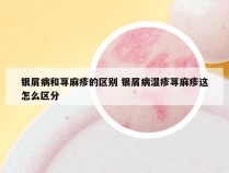 银屑病和荨麻疹的区别 银屑病湿疹荨麻疹这怎么区分