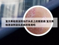 复方黄柏液涂剂治疗头皮上的银屑病 复方黄柏液涂剂涂头皮真的有用吗