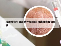 玫瑰糠疹与银屑病外观区别 玫瑰糠疹和银屑病