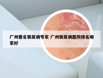 广州著名银屑病专家 广州银屑病医院排名哪家好