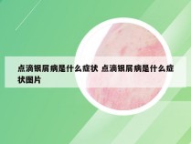点滴银屑病是什么症状 点滴银屑病是什么症状图片