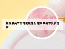 银屑病关节炎可出现什么 银屑病关节炎表现有