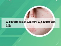 头上长银屑病是怎么发现的 头上长银屑病怎么治