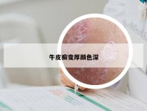 牛皮癣变厚颜色深