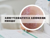太原哪个牛皮癣治疗好方法 太原看银屑病医院哪家最好