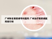 广州知名银屑病专科医院 广州治疗银屑病医院排行榜