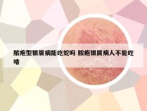 脓疱型银屑病能吃蛇吗 脓疱银屑病人不能吃啥