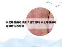 头皮牛皮癣可以用卡泊三醇吗 头上牛皮癣可以用他卡西醇吗