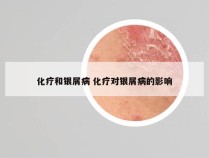 化疗和银屑病 化疗对银屑病的影响