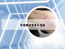 牛皮癣适宜多久洗澡