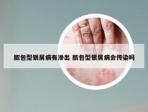 脓包型银屑病有渗出 脓包型银屑病会传染吗