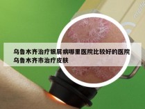 乌鲁木齐治疗银屑病哪里医院比较好的医院 乌鲁木齐市治疗皮肤