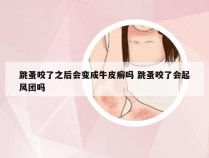 跳蚤咬了之后会变成牛皮癣吗 跳蚤咬了会起风团吗