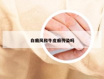 白癜风和牛皮癣传染吗