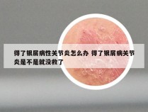 得了银屑病性关节炎怎么办 得了银屑病关节炎是不是就没救了