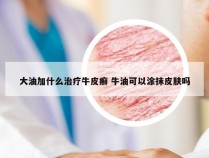 大油加什么治疗牛皮癣 牛油可以涂抹皮肤吗
