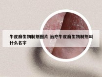 牛皮癣生物制剂图片 治疗牛皮癣生物制剂叫什么名字