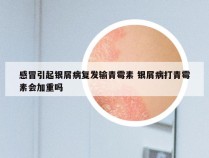 感冒引起银屑病复发输青霉素 银屑病打青霉素会加重吗