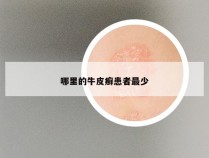 哪里的牛皮癣患者最少