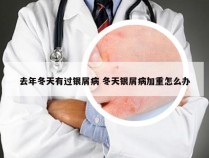 去年冬天有过银屑病 冬天银屑病加重怎么办