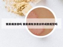 银屑病渗液吗 银屑病有渗液会转成脓疱型吗