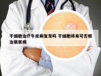 干细胞治疗牛皮癣复发吗 干细胞将来可否根治银屑病