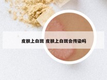 皮肤上白斑 皮肤上白斑会传染吗